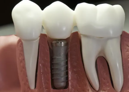 植入种植体：开启种植牙之旅