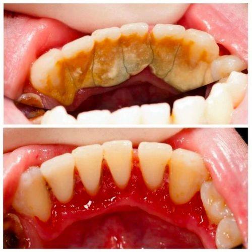 长期口腔护理的刷牙注意