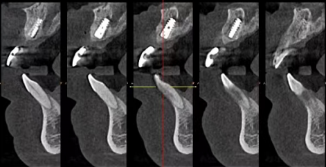 不同年龄段种植牙寿命的差异