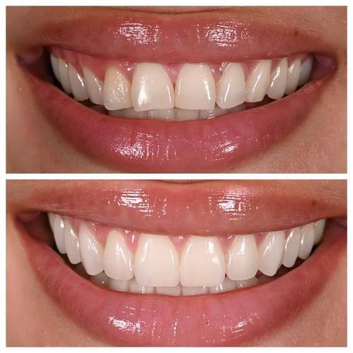 磨牙过程可能带来的不适与风险