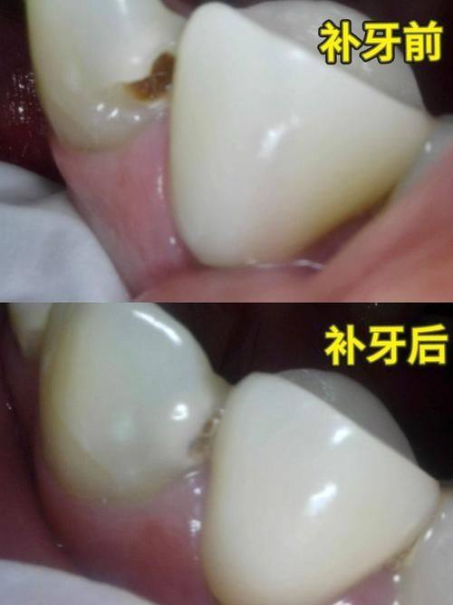 及时补牙，避免费用增加
