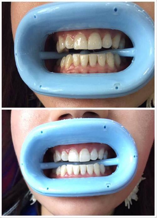 洗牙：清洁与美白的基础