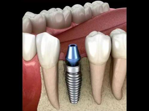 影响种植牙价格的地域因素