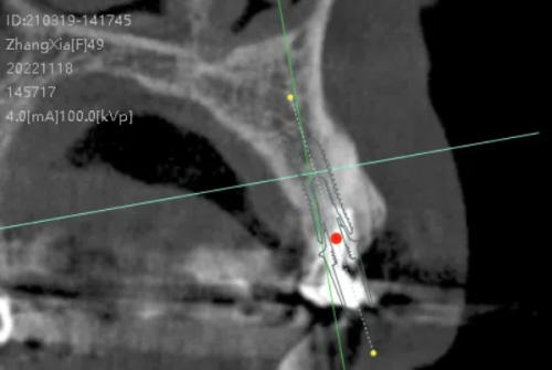 如何合理规划种植牙时间