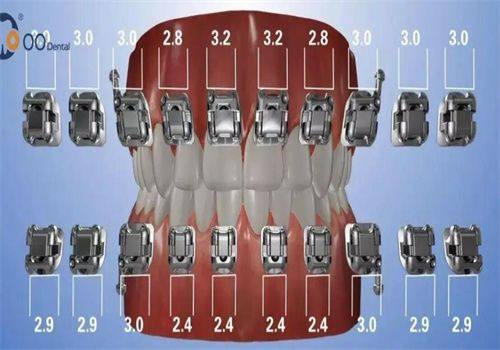 不同矫正方式的价格差异