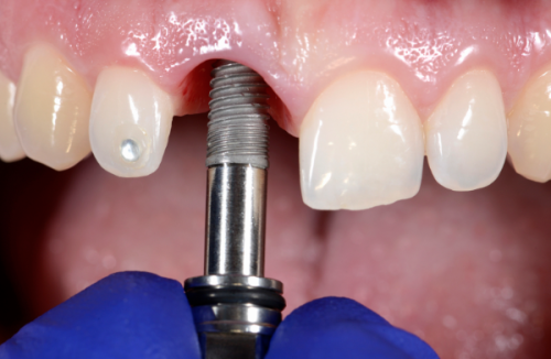 种植牙后牙床问题的解决方案