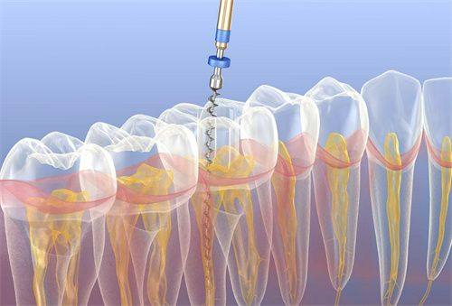 根管治疗一颗牙多少钱？2026年最新费用解析！