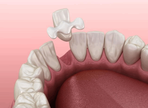 烤瓷牙和全瓷牙有什么区别？哪个更适合你？