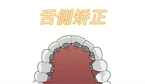 矫正方式决定费用高低