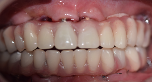 应对种植牙费用的策略