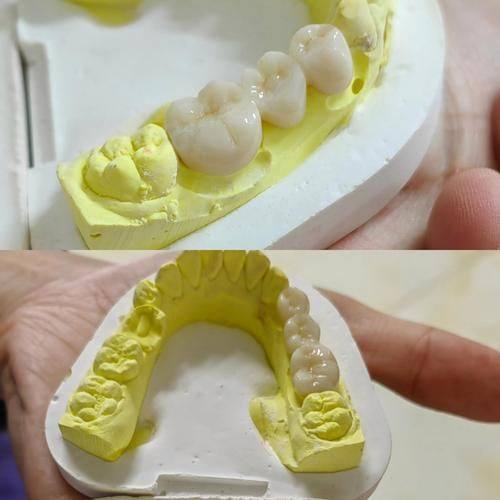 维护全瓷牙套寿命的建议