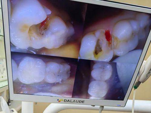 补牙后：做好注意事项