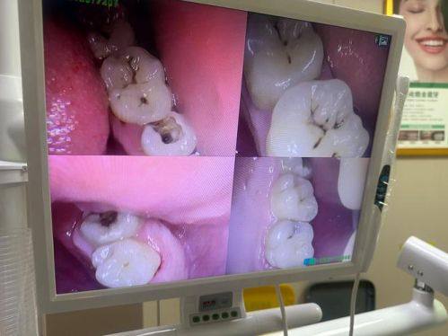 影响补牙医疗保险报销的因素
