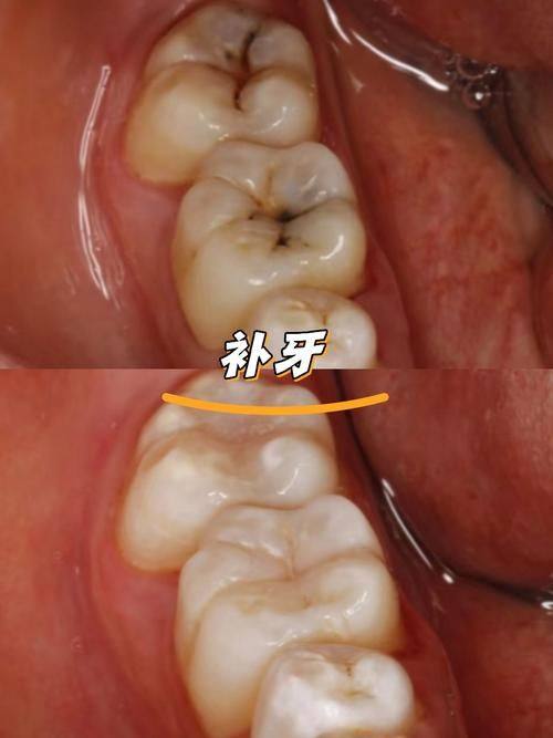 补牙医疗保险报销的常见误区