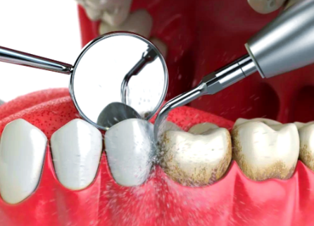 洗牙通常无害的原因