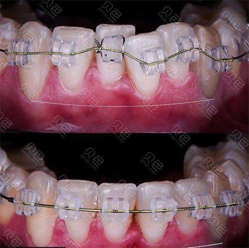 牙齿矫正的最晚年龄段：你知道吗？最佳年龄揭秘！