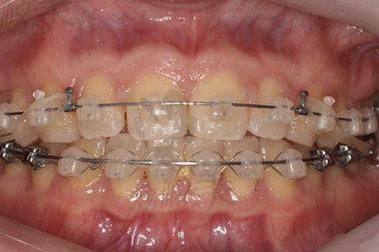 高龄人群牙齿矫正的可行性