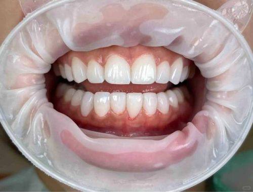 美白之后，做好防护