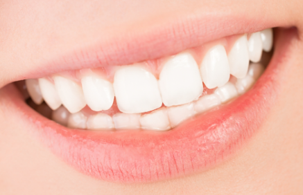 影响牙齿美白价格的其他因素