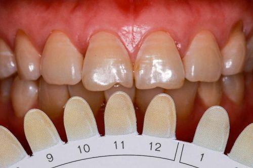 冷光美白的缺点大揭秘