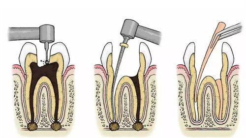 影响根管治疗次数的其他因素
