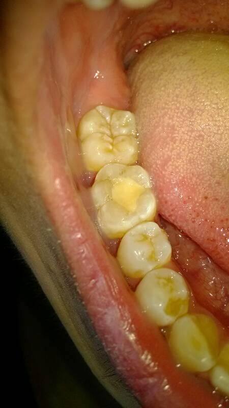 龋齿不处理会一直烂吗？揭秘牙齿健康的真相与影响！