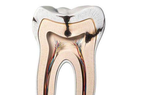 发现龋齿后该怎么办