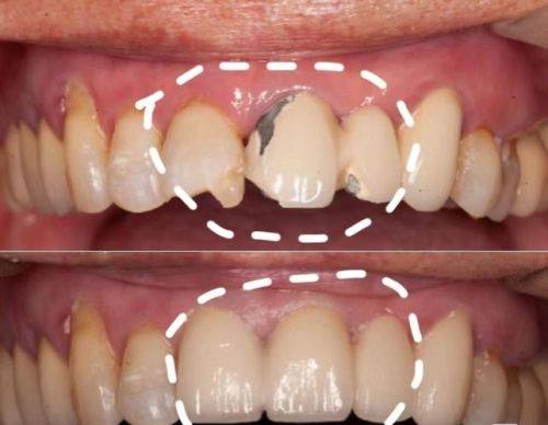 为什么选择400元一颗的全瓷牙冠？口腔健康新选择！