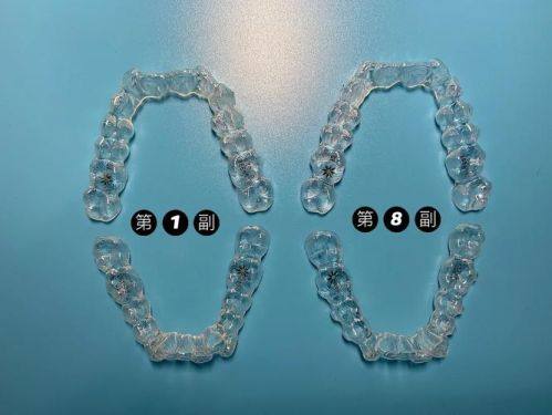 影响牙套价格的其他因素