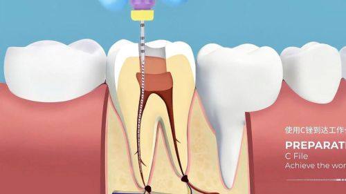 根管治疗后必须做牙冠吗？了解真相与必要性！