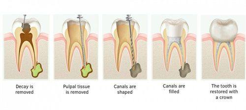 第三步：根管填充