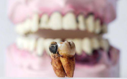 损伤口腔黏膜：粗糙牙冠的“隐形杀手”