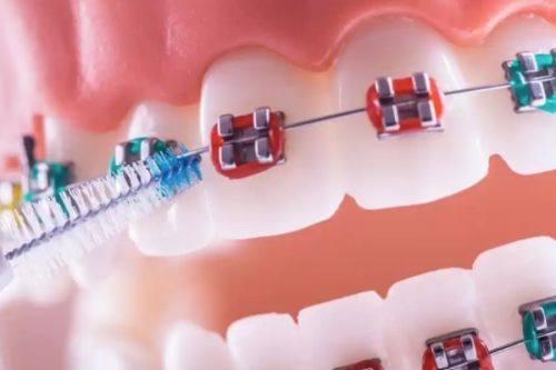 如何选择适合自己的矫正方案和控制费用