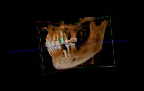 种植手术:精细植入,开启新生