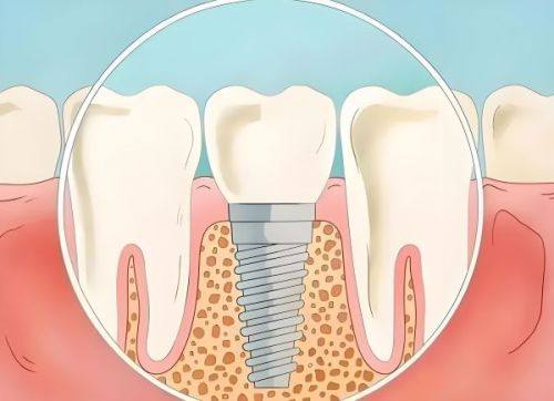缓解种植牙疼痛的方法