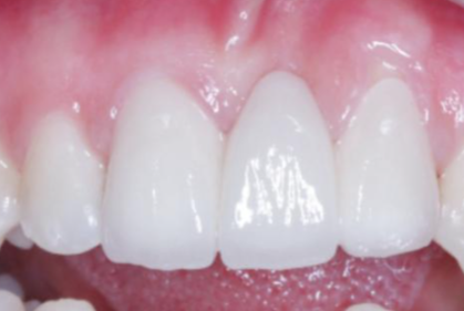全瓷牙套的4大危害要当心！你知道吗？