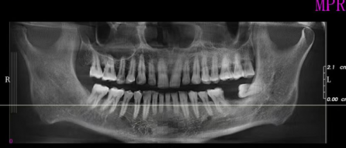 影响种植牙总时长的因素