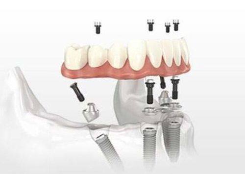 如何降低种植牙的危害