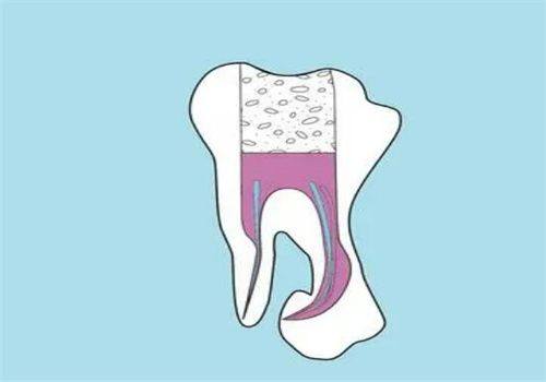 根管治疗后必须做牙冠吗？3个关键点你需要知道！