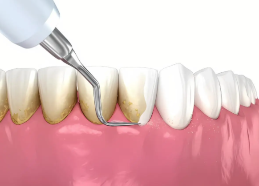 洗牙频率的正确选择方法