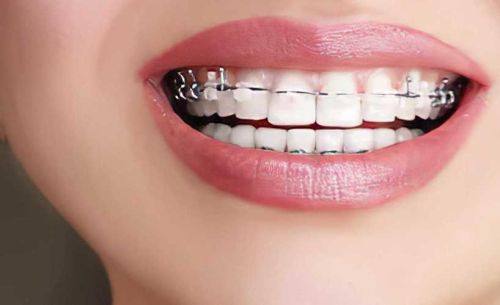 牙齿矫正医疗保险报销政策明确规定