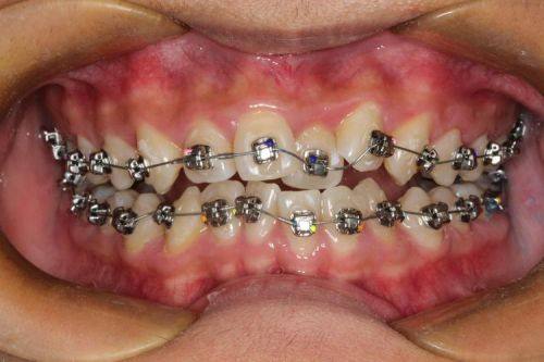 个体配合情况对佩戴时长的影响