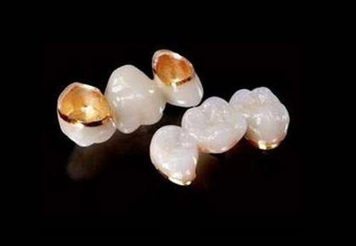 不同类型烤瓷牙价格大揭秘