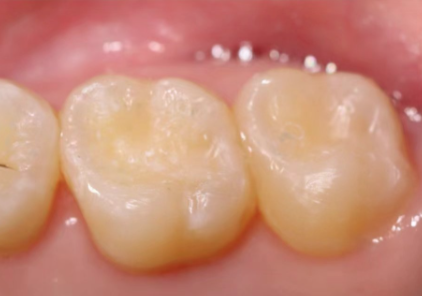 银汞补牙可能存在的危害情况