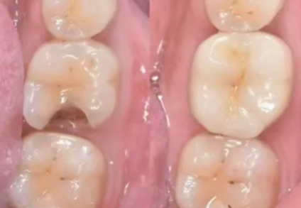 北京补牙齿一般多少钱？2026年最新价格揭秘！