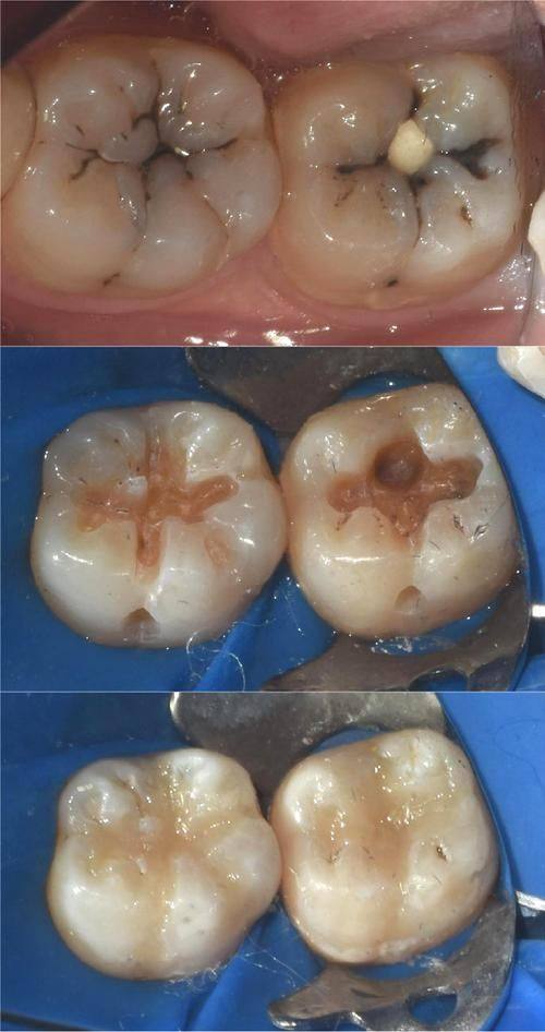 牙齿情况决定费用