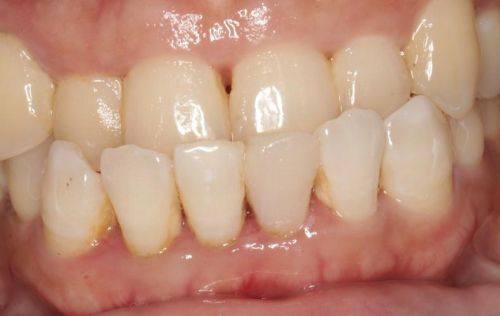 第三次治疗:根管封闭与补牙