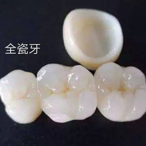 影响国产全瓷牙套价格的因素
