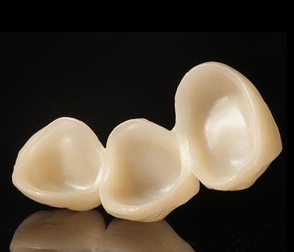 如何选择适合自己的国产全瓷牙套