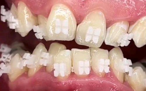 牙套粘回后的注意事项